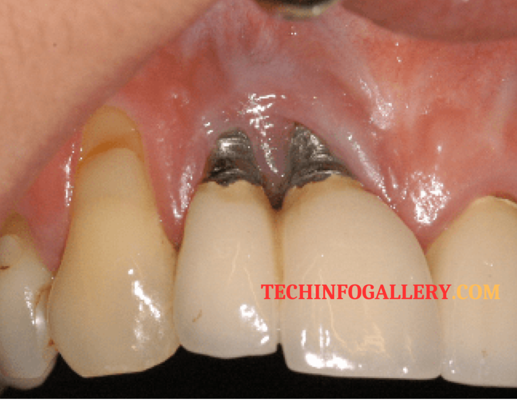 कृत्रिम दांत (Dental Implants)