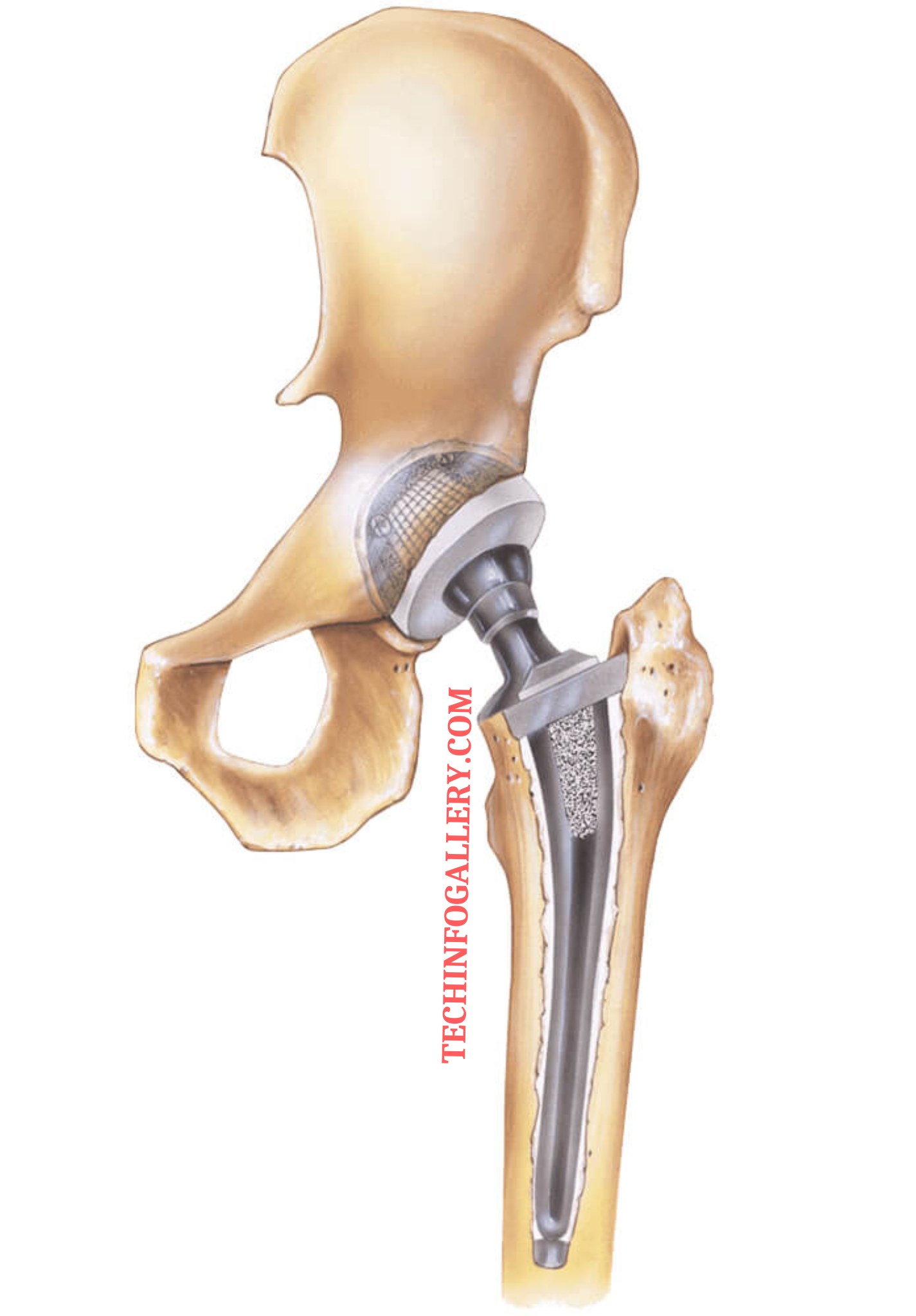 कृत्रिम कूल्हा (Artificial Hip