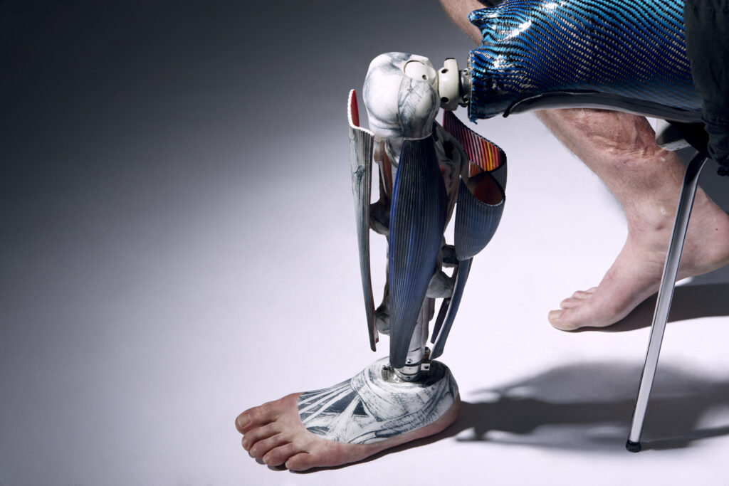 कृत्रिम घुटना (Artificial Knee)