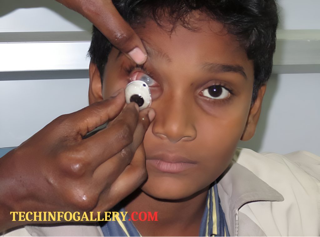 कृत्रिम आंख (Artificial Eye