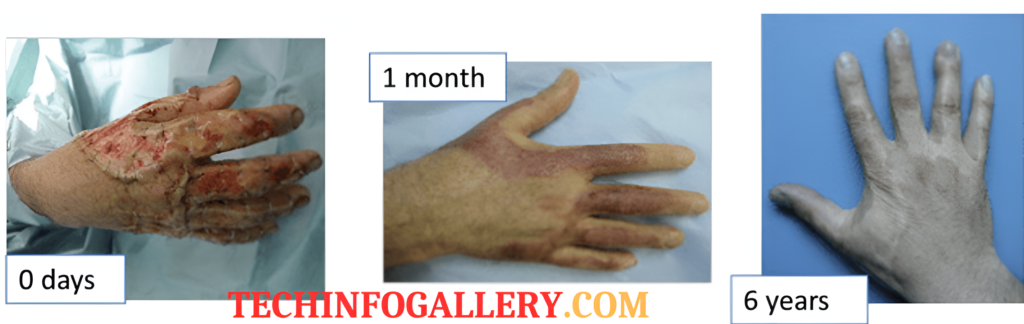 कृत्रिम त्वचा (Artificial Skin)
